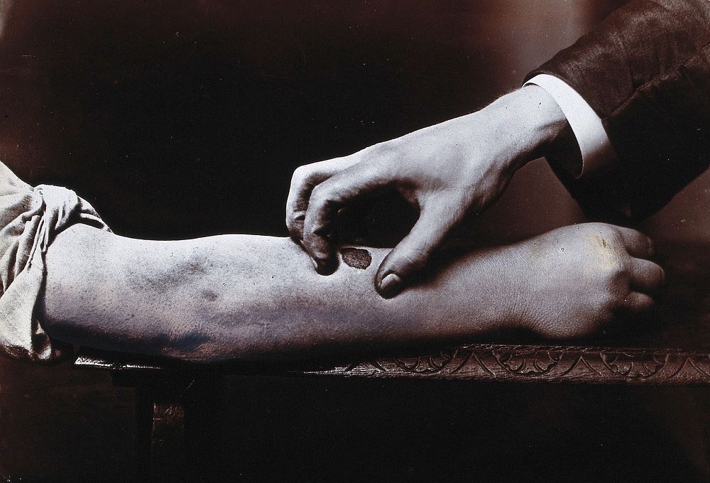 A hand held over a dark mark on a forearm, to demonstrate the manual treatment of ulcers. Photograph.