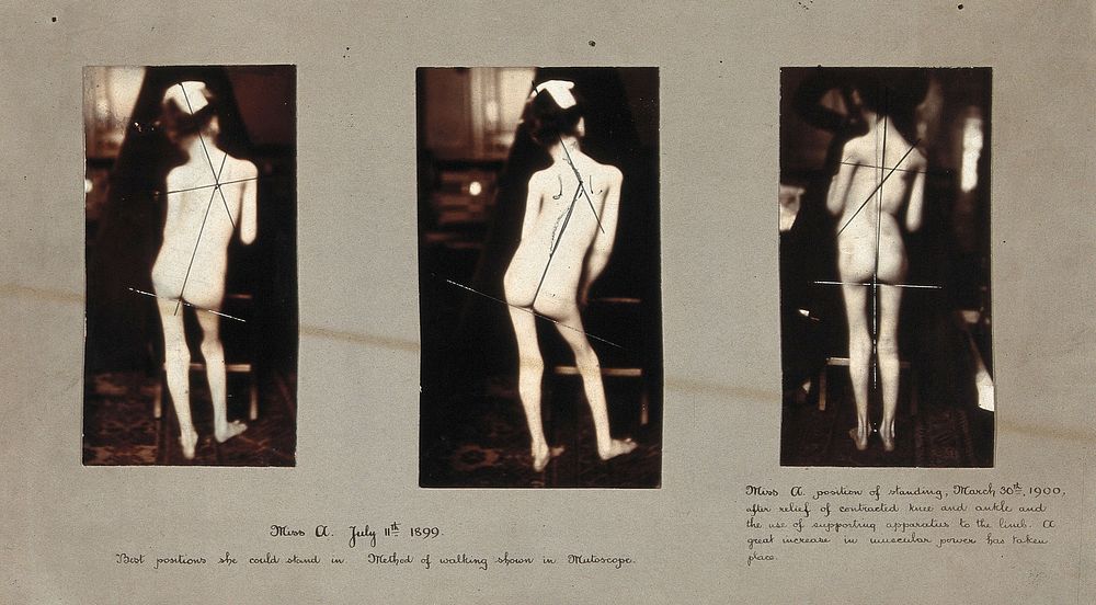 A girl with osteopathic problems, standing; three views. Photographs, 1899 - 1900.