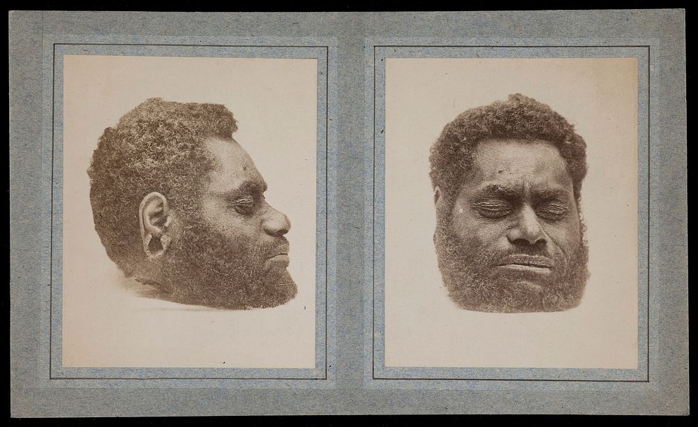 The decapitated head of a man: two views. Photographs, 18--.