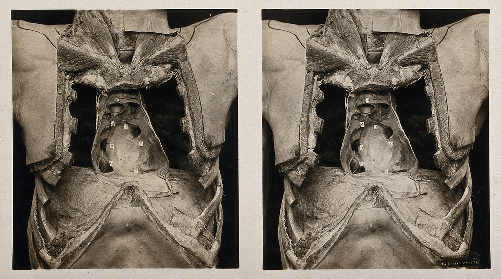 Anatomy: a dissection of the thorax showing the heart and pericardium. Photograph, ca. 1900.
