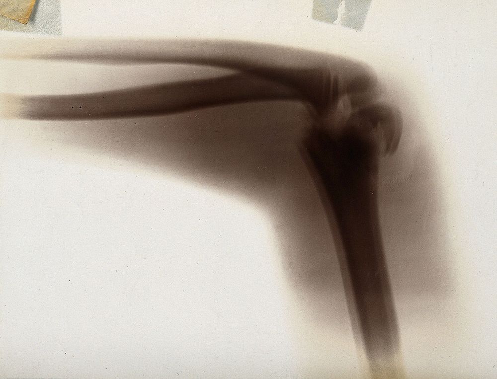 The fracture and dislocation of bones in an elbow joint, viewed through x-ray. Photoprint from radiograph after Sir Arthur…