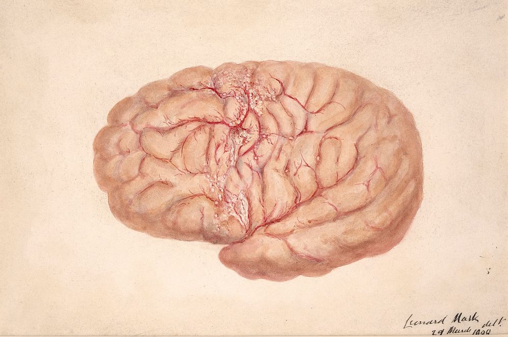 Left cerebral hemisphere of a child who died from tubercular meningitis