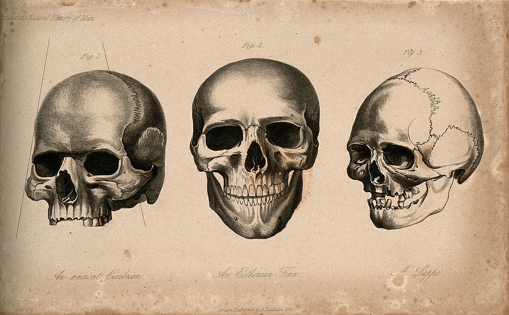 Human skulls: three figures showing the skulls of an ancient Cimbrian, an Estonian and Laplander. Stipple engraving, 1843.
