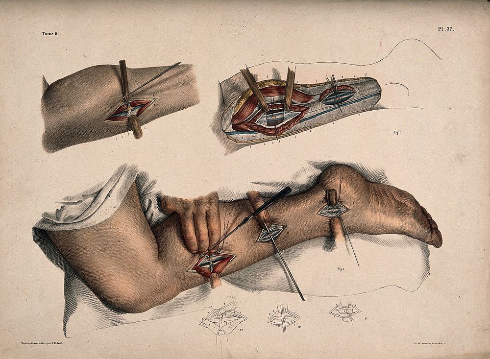 An operation being performed on a leg and ankle. Coloured lithograph by N.H. Jacob after himself.