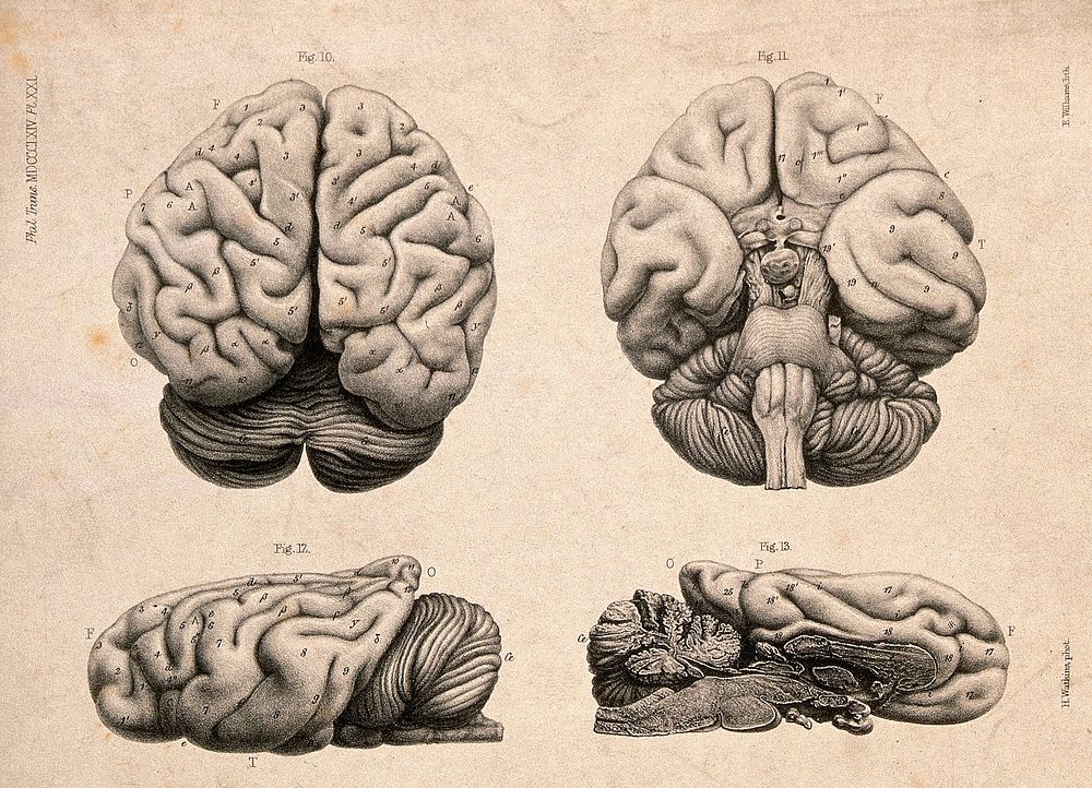 Brain of a "European female idiot" aged 42 years: four figures. Lithograph by E.M. Williams after H. Watkins, 1864.