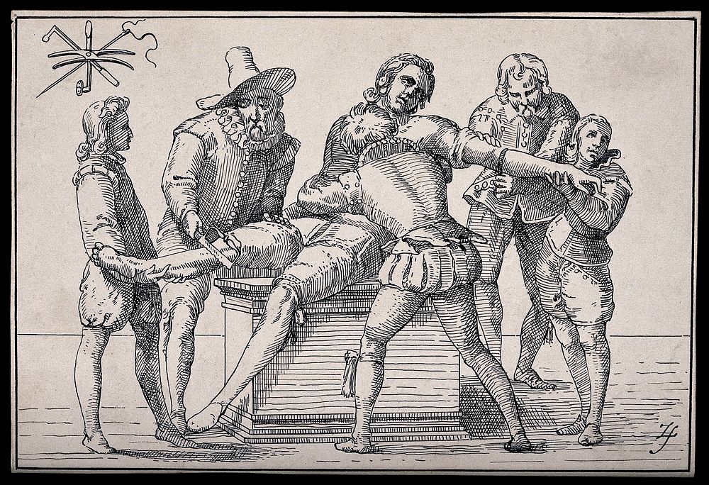 Two surgeons amputating the leg and arm of the same patient who is being restrained by assistants. Pen drawing after an…