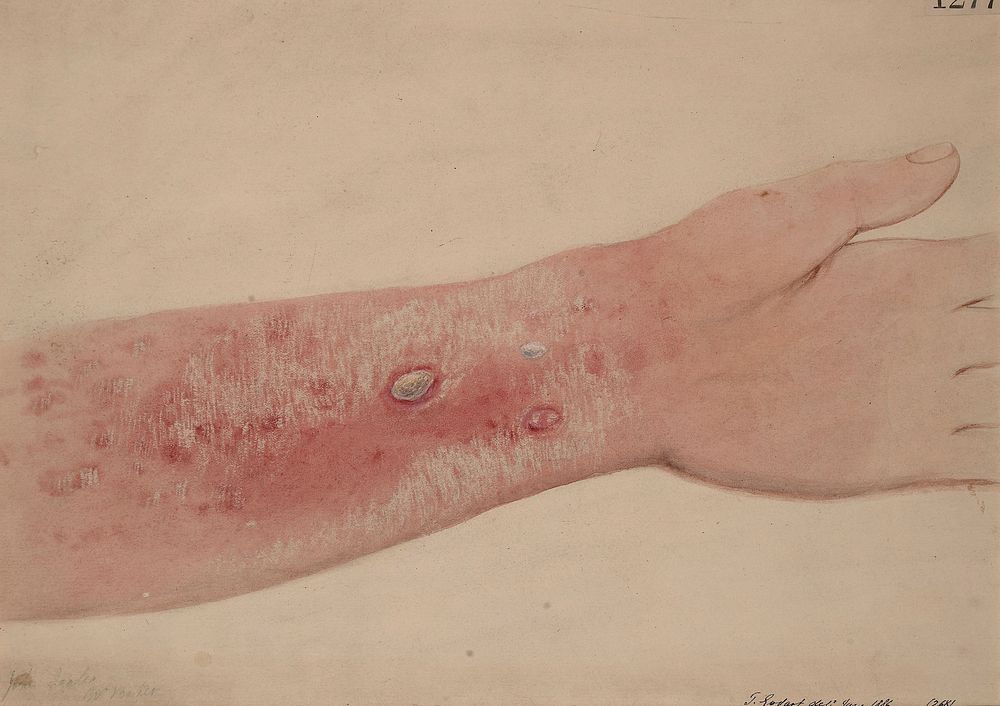 Left forearm of a wax-refiner who had a large recurrent epitheliomatous growth