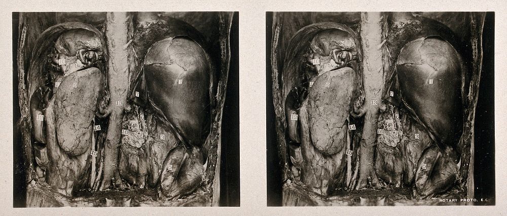 Anatomy: a dissection of the lumbar region showing the anterior relations of the kidneys. Photograph, ca. 1900.