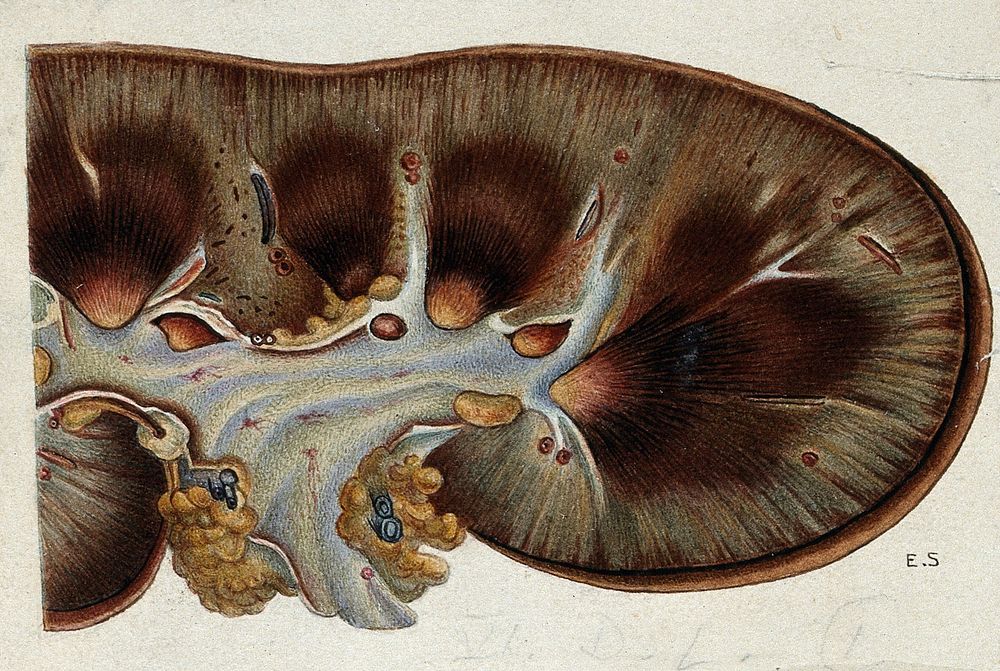 Yellow fever: section of a kidney of a patient infected with yellow fever. Watercolour, 1900/1930 .