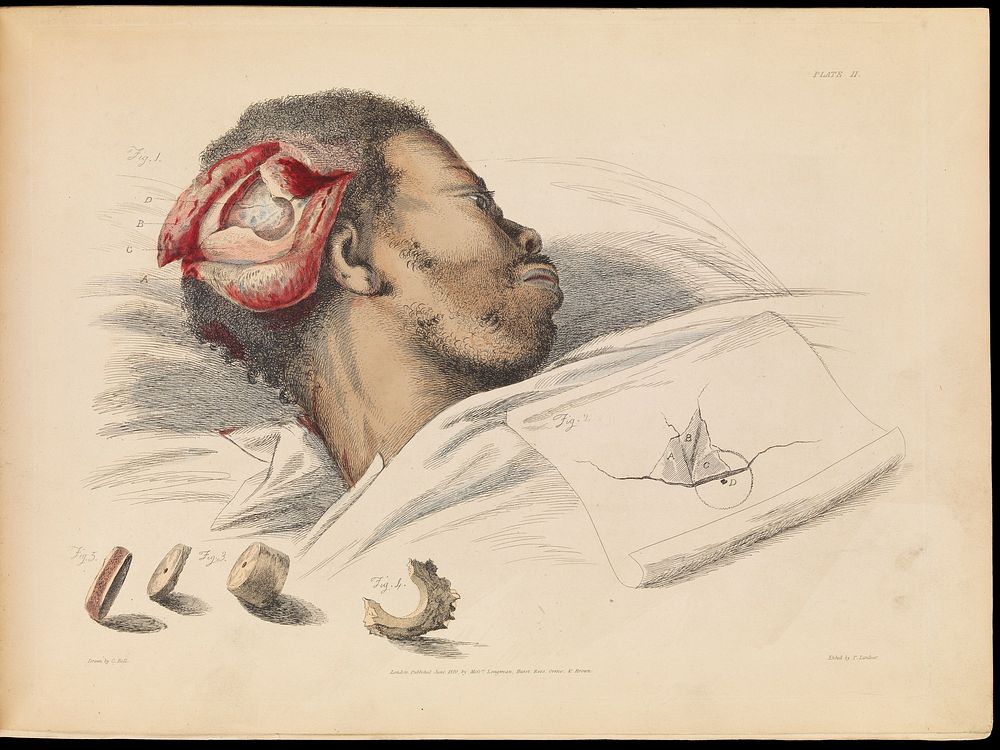Plate II, illustration of trephination. Sir Charles Bell