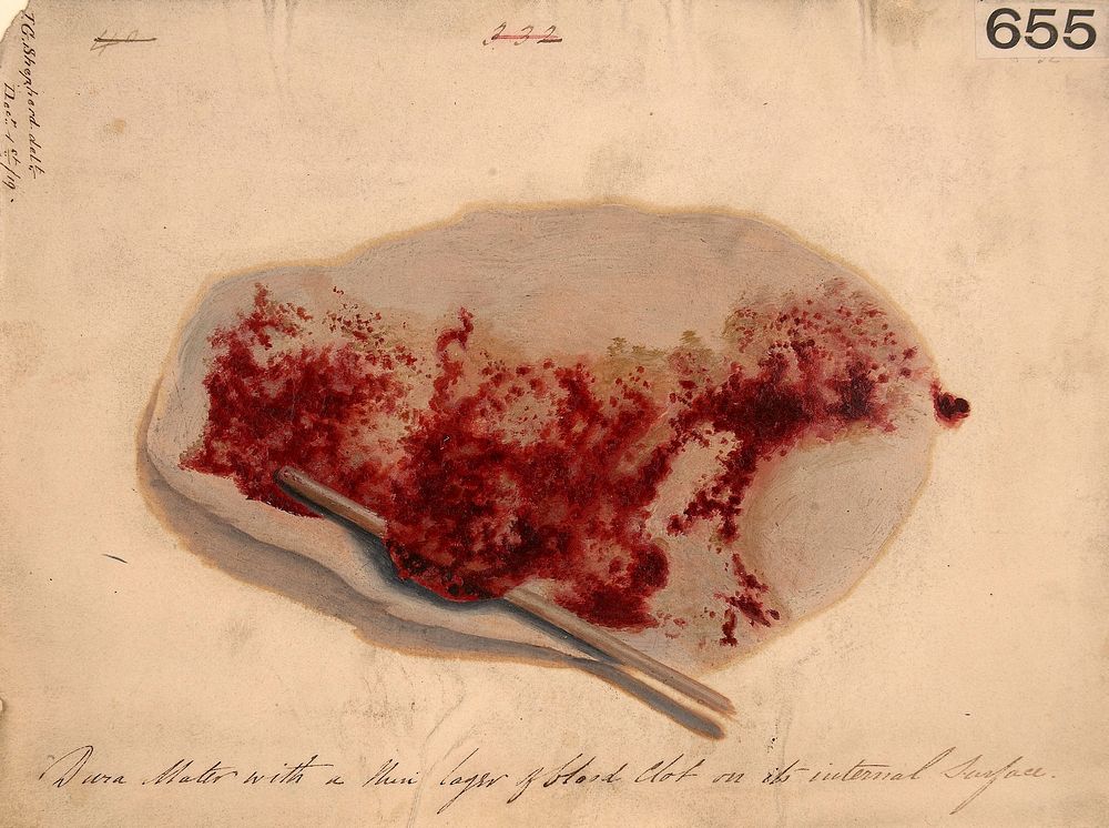 Dura mater, with a thin layer of blood clot on its internal surface