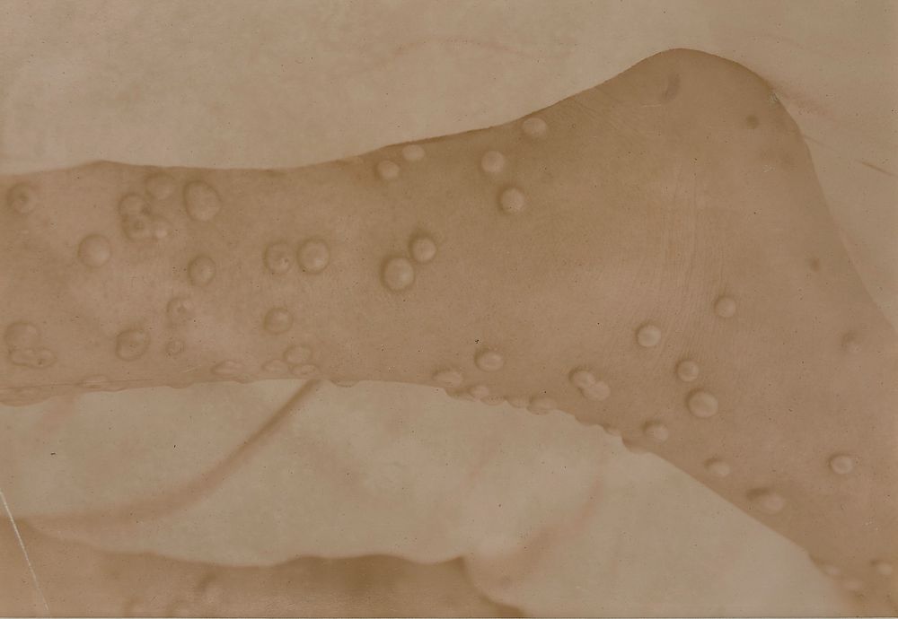 Foot of a child with smallpox and early scarlet fever, 11th day of eruption
