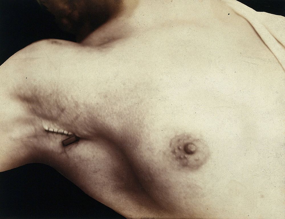 A breast operation to remove a lump, in progress: an incision in the armpit which has been sewn up. Photograph by Félix…