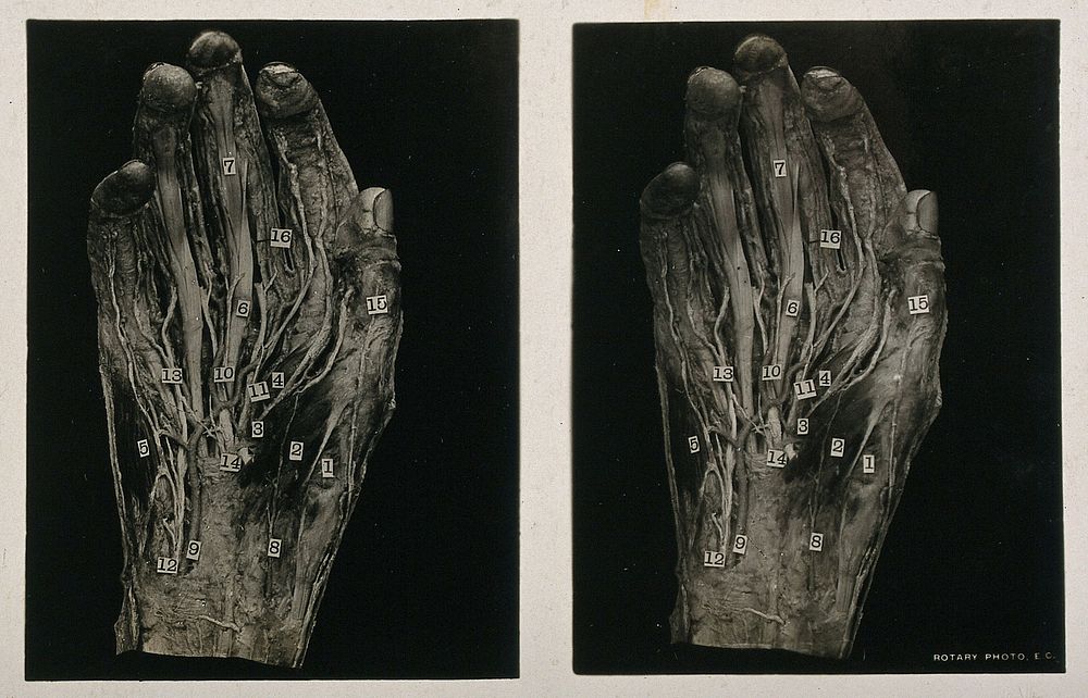 Anatomy: écorché palm of the hand showing muscles, nerves, vessels and tendons. Photograph, ca. 1900.