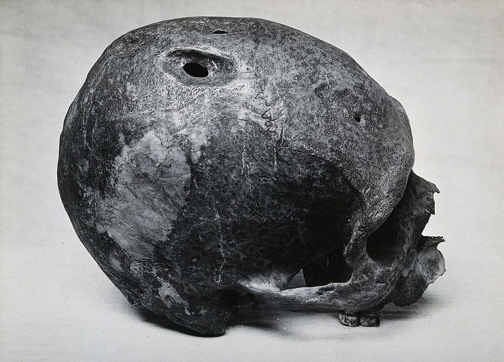 A trephined human skull. Photograph.