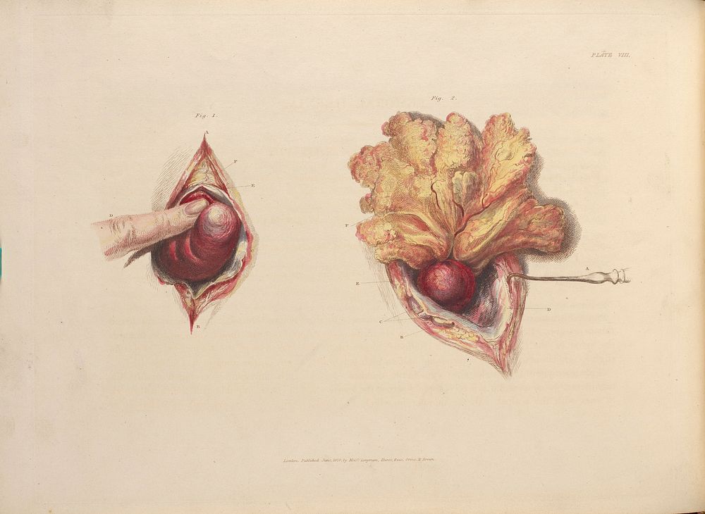 Plate VIII, Illustration of a femoral hernia.