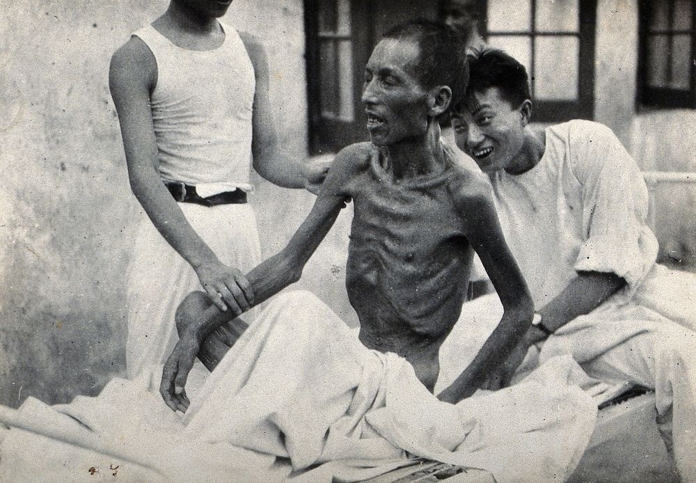 An emaciated man, rescued from a premature burial, being helped to sit up on an outdoor hospital bed. Photograph.