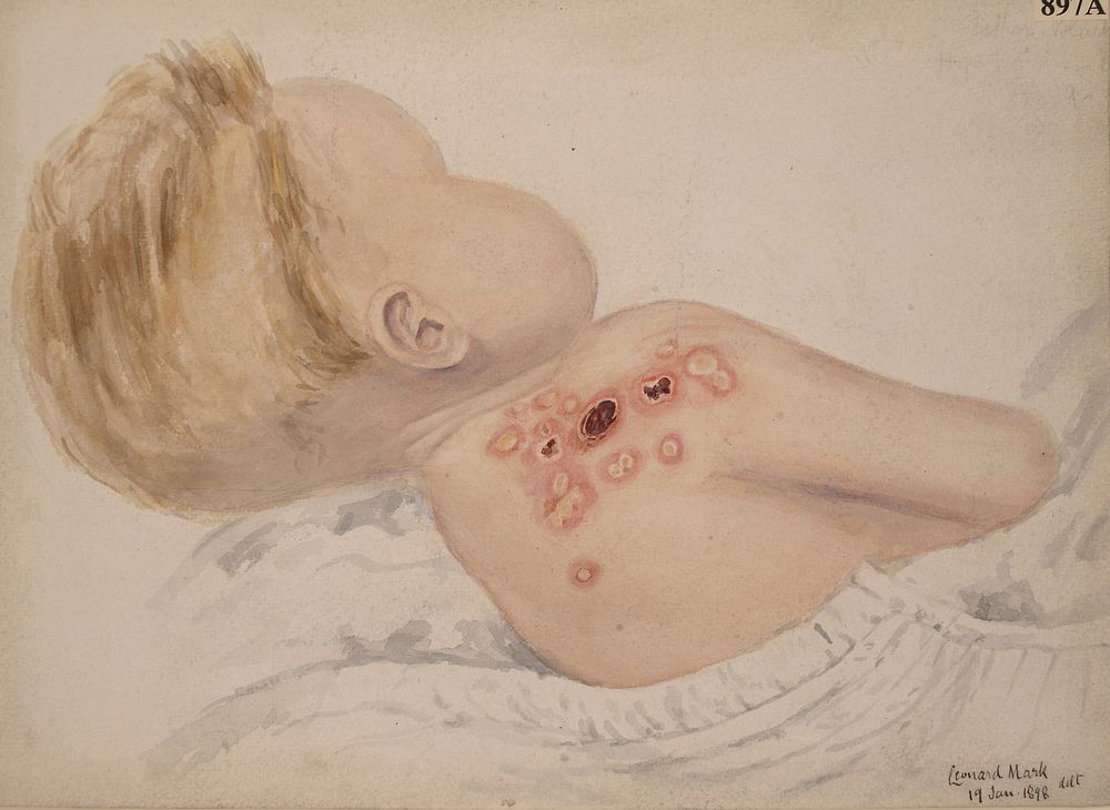 Child with an eruption of an echthymatous nature on the right shoulder
