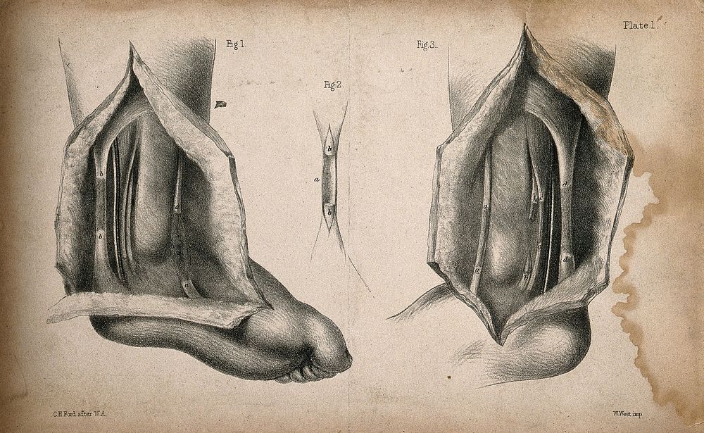 Tendons of the ankle: three figures of a dissection. Lithograph by G.H. Ford after W.A., 1850/1870.