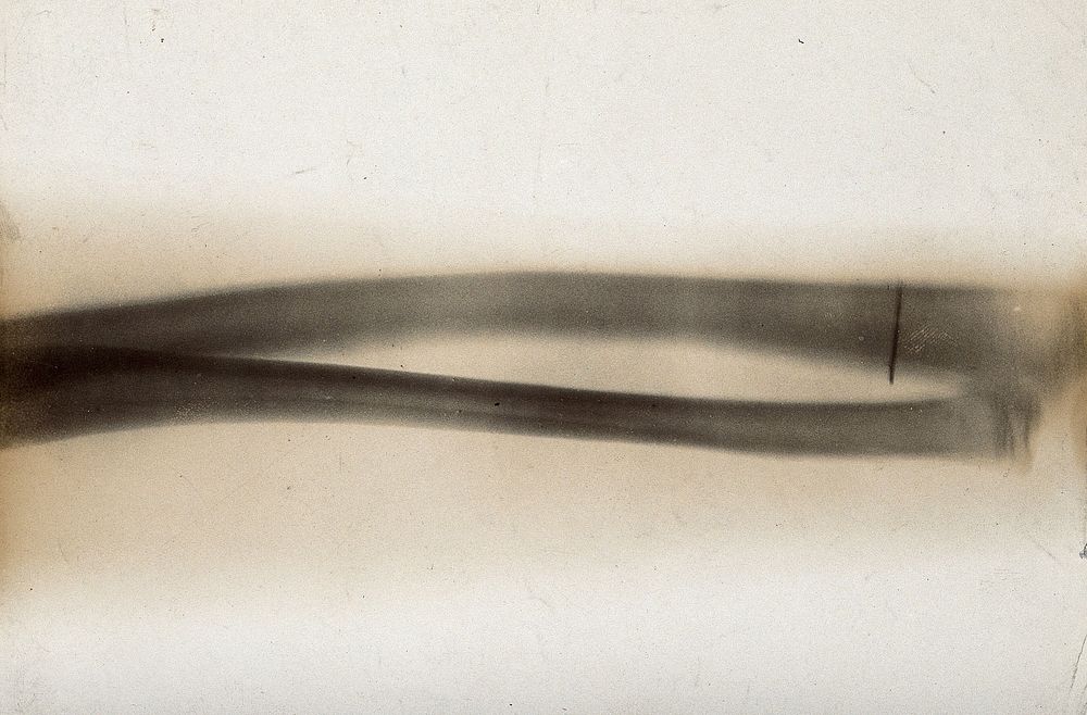 The bones of the radius and ulna, viewed through x-ray. Photoprint from radiograph after Sir Arthur Schuster, 1896.