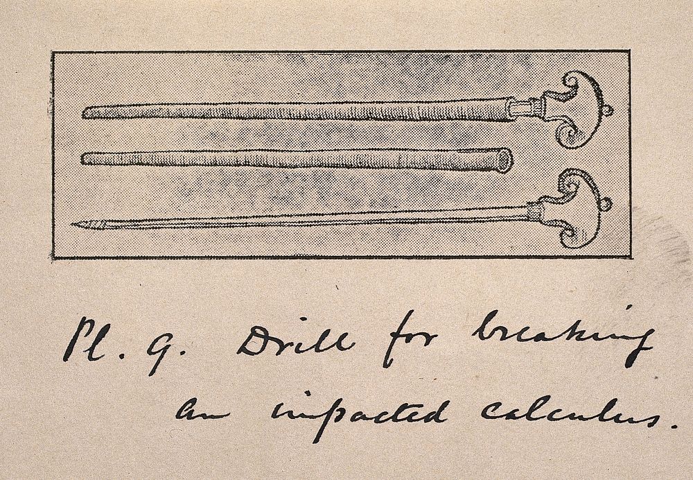 A drill for breaking an impacted calculus: three figures. Process print, 1890/1910.