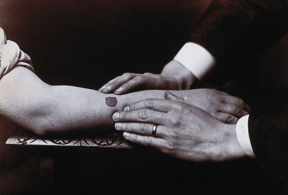Two hands held on either side of a dark mark on a forearm, to demonstrate the manual treatment of ulcers. Photograph.