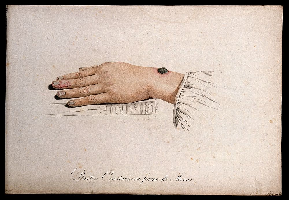 A hand with a skin disease on the wrist and finger. Coloured stipple engraving by S. Tresca after Moreau-Valvile, c. 1806.