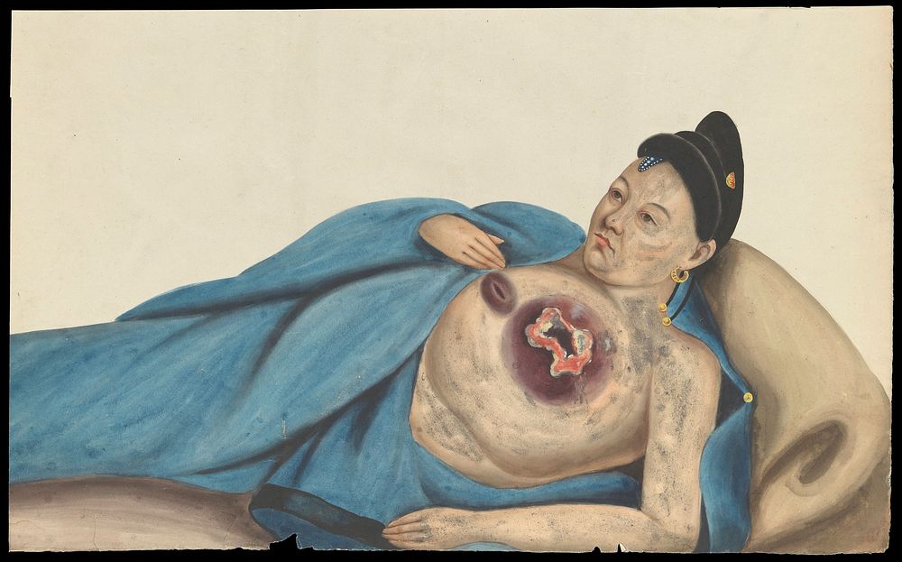 A woman, reclining, with a large tumour on her left breast. Gouache, 18--, after Lam Qua, ca. 1837.