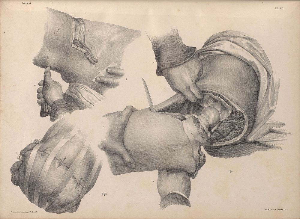 Plate 87, Amputation at the hip joint.