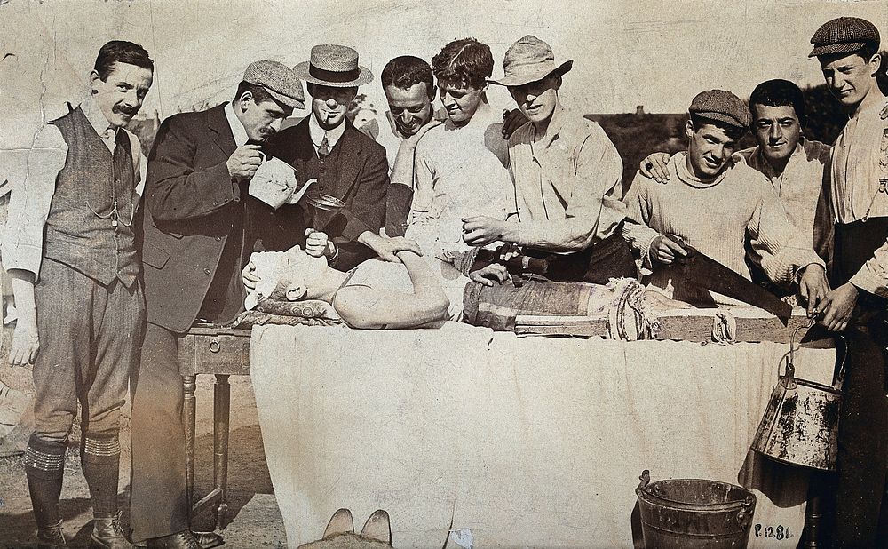 Staging of a leg amputation: the 'patient' lies on a table surrounded by men: one man poses with a saw, two men pretend to…