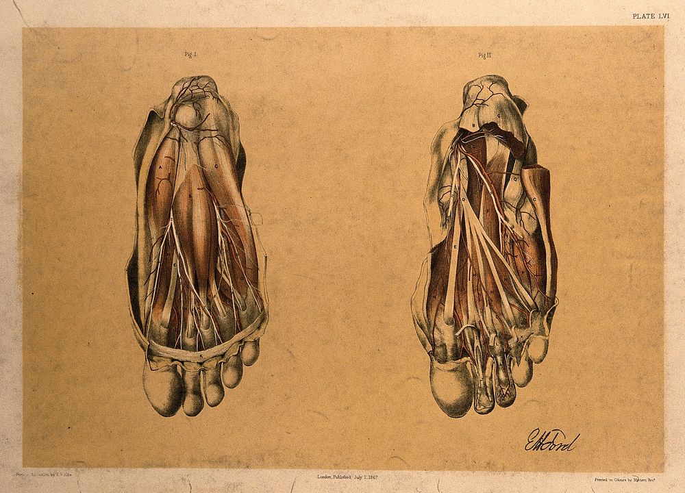 Dissections of the underside of the foot, showing the muscles and blood vessels: two figures. Colour lithograph by G.H.…
