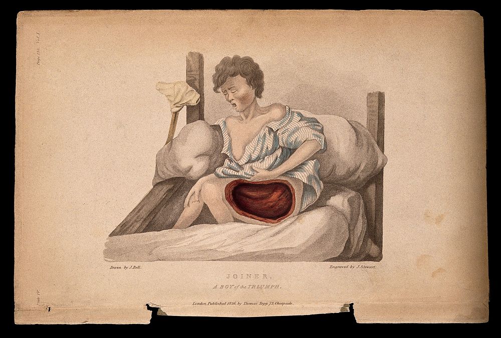 A boy with a wounded thigh seated on a bed; a crutch to his right. Coloured stipple etching by J. Stewart after J. Bell, c.…