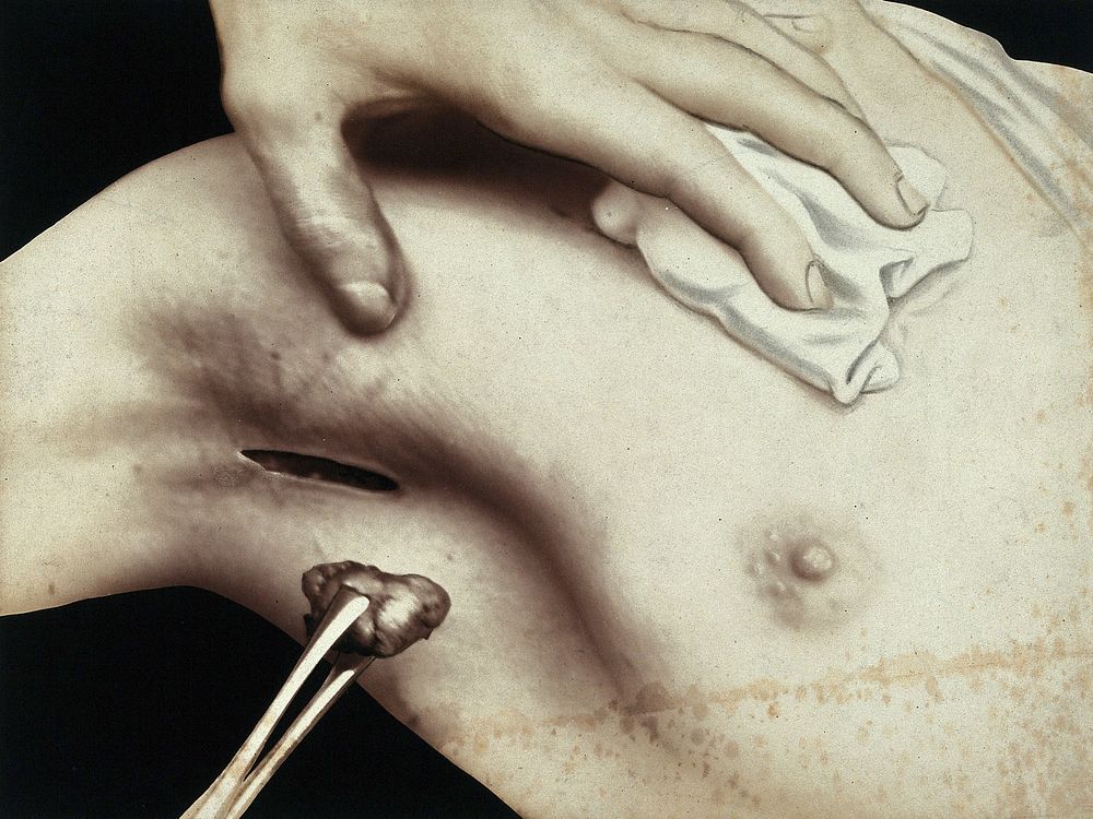 A breast operation to remove a lump, in progress: metal surgical tongs hold a lump taken from the breast via an incision in…