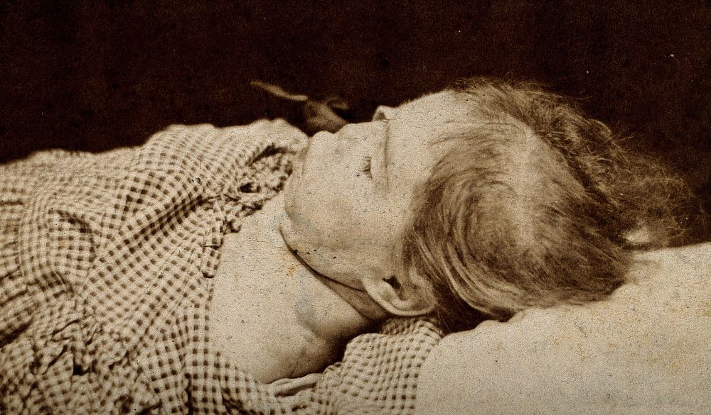 The head and shoulders of a child, showing signs of mental deficiency, seen in profile lying down. Photograph by J. Keens.