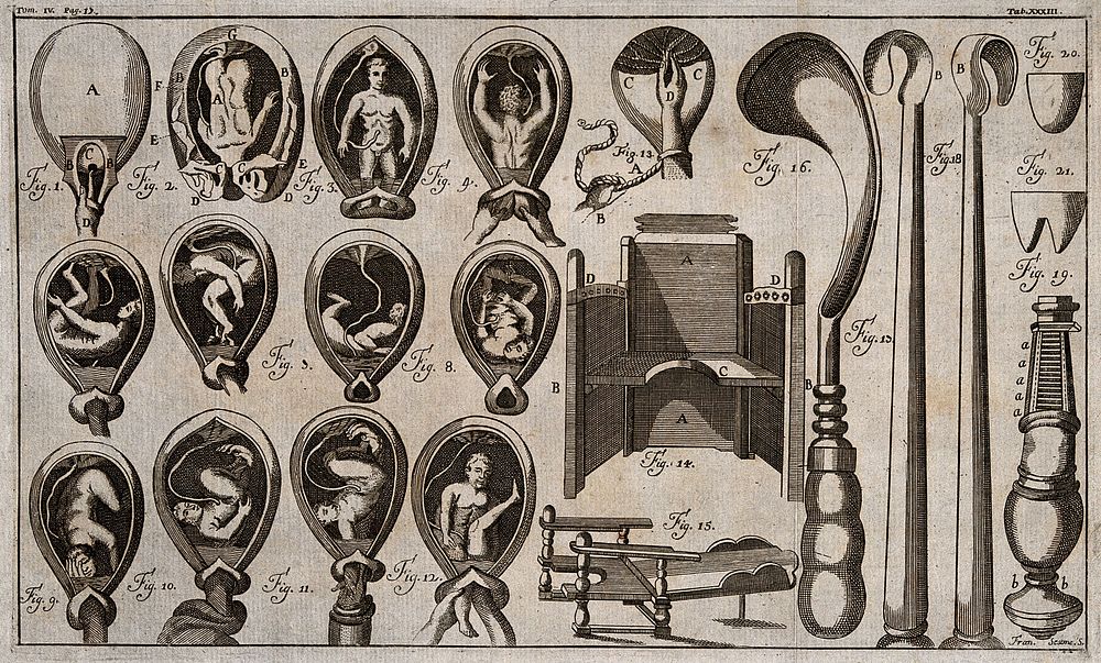 Thirteen diagrams of a child in the womb in various positions; two obstetrical chairs and several obstetrical instruments.…