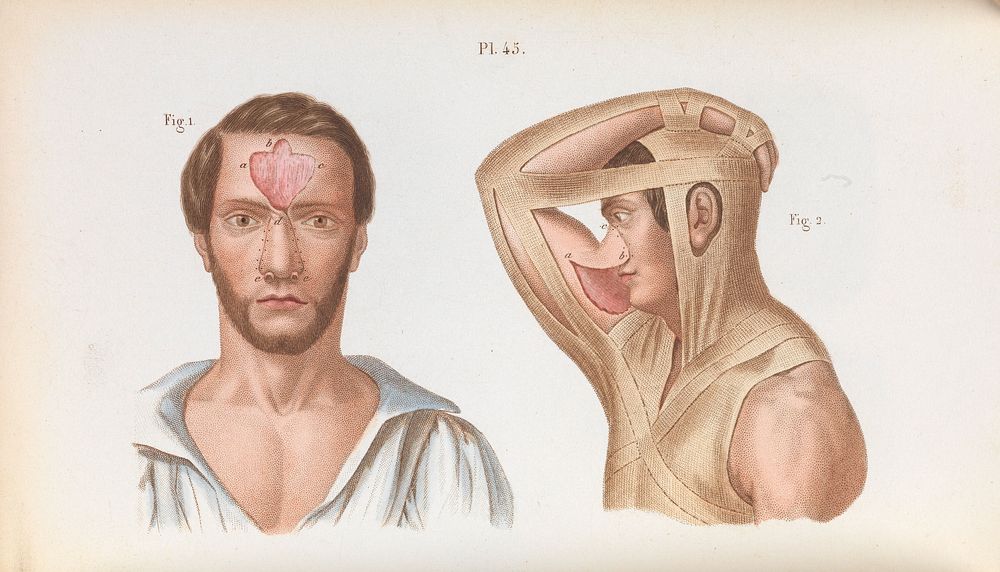 Plate 45, Plastic surgery of the nose.