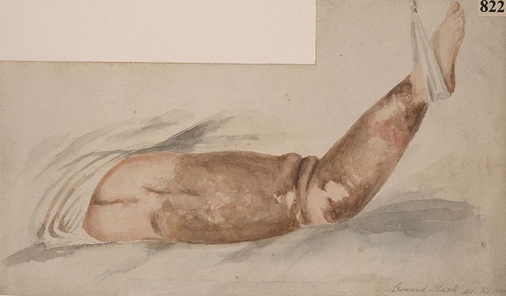 Leg of a woman with an advanced ichthyotic condition of the skin