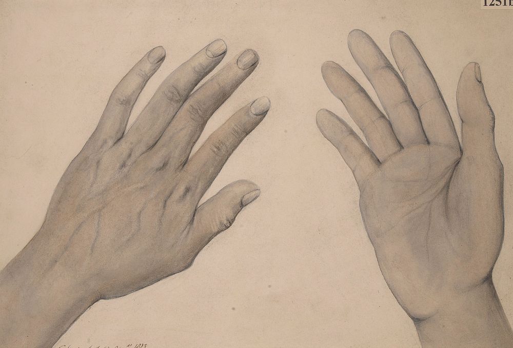 Hands of a man with peculiar staining of the skin, caused by melanotic sarcomata