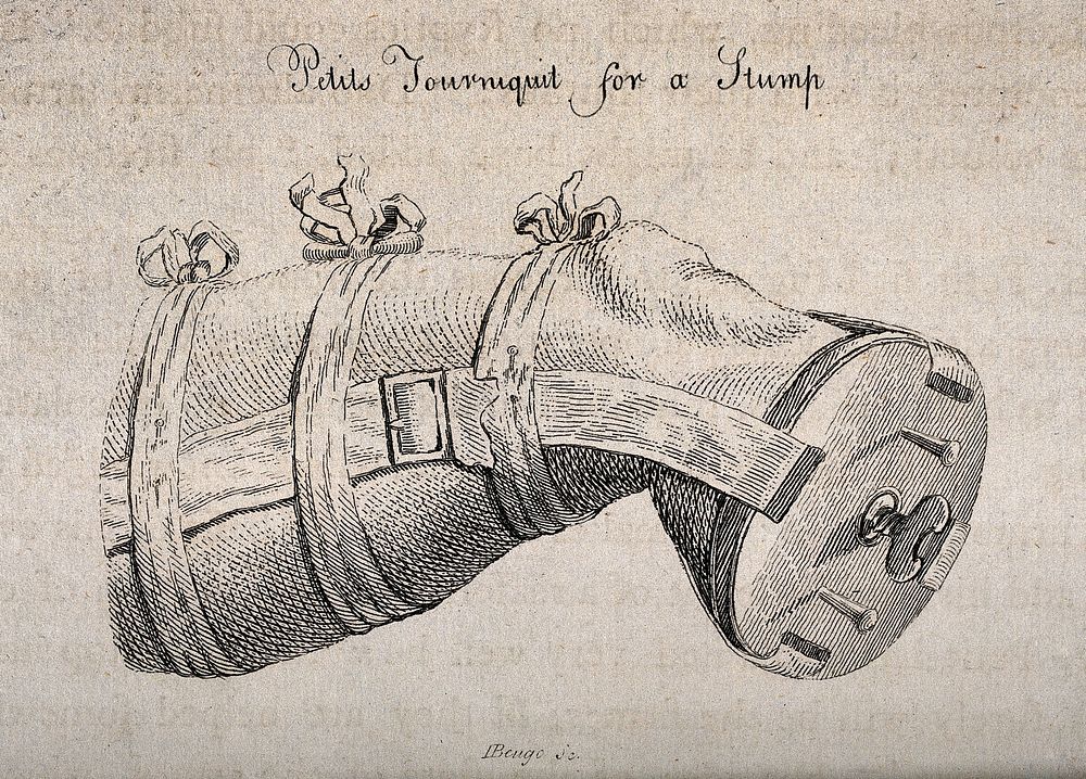 An amputated leg in a tourniquet supported by a piece of wood that covers the end of the stump. Engraving by J. Beugo.