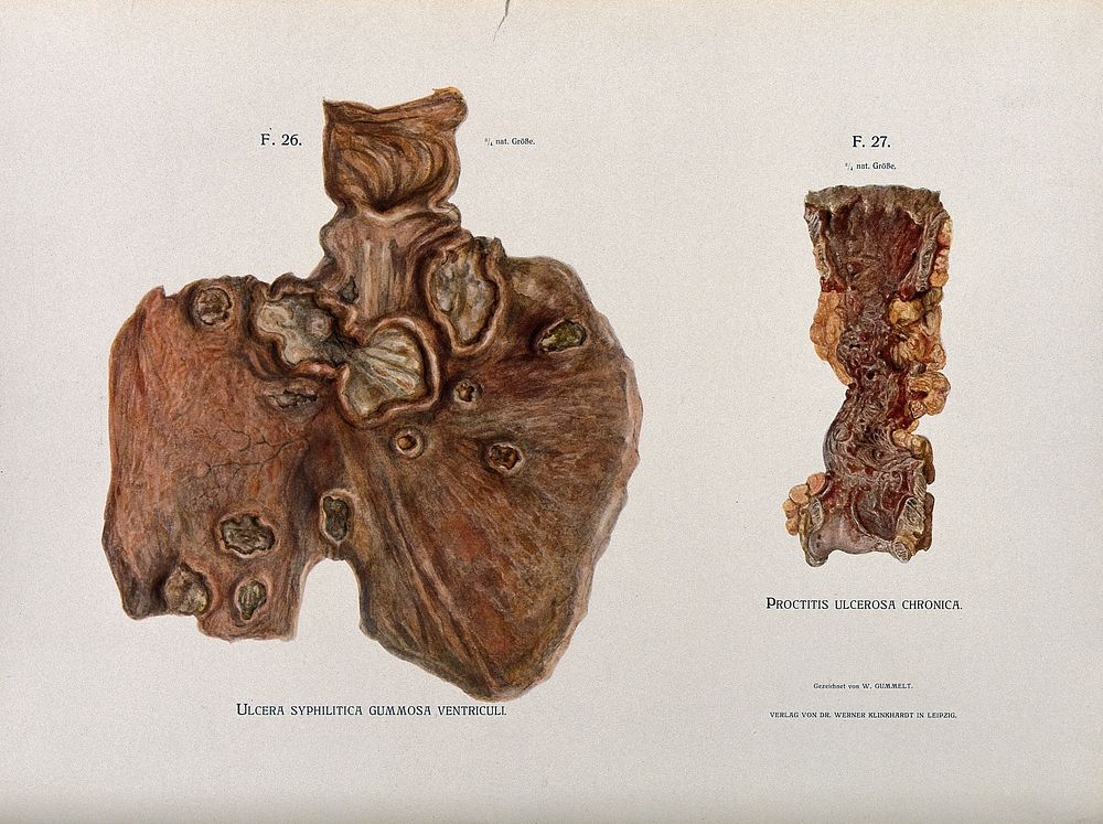 Dissections of an ulcerated stomach caused by syphilis, and a severe case of ulcerated proctitis of the rectum : two…
