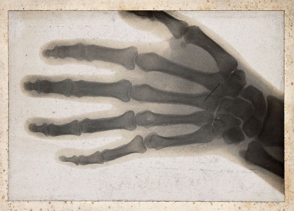 The bones of a hand, viewed through x-ray; possibly with a needle just below the wrist. Photoprint from radiograph after Sir…