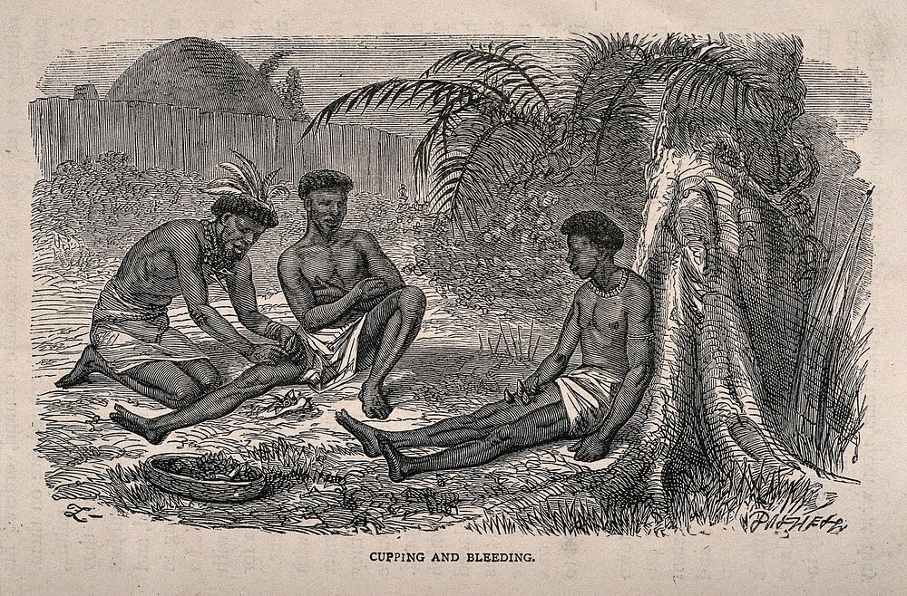 An African medicine man cupping and bleeding two patients. Wood engraving by Dalziel after J. Leech.