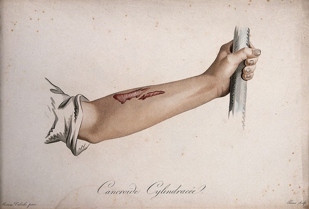 A forearm with a skin disease. Coloured stipple engraving by S. Tresca after Moreau-Valvile, c. 1806.