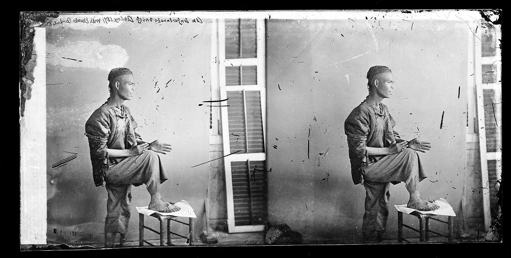 Amoy (Xiamen), Fukien province, China: a thief with his thumbs chopped off. Photograph by John Thomson, 1871.