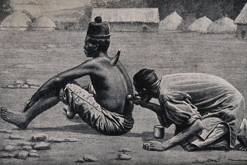 An African medicine man or shaman applying the technique of cupping to a patient (using animal horns), which involves…