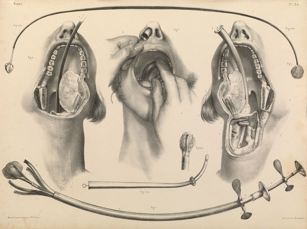 Traité complet de l'anatomie de l'homme comprenant la médecine opératoire ... : avec planches lithographiées ... / par N.H.…