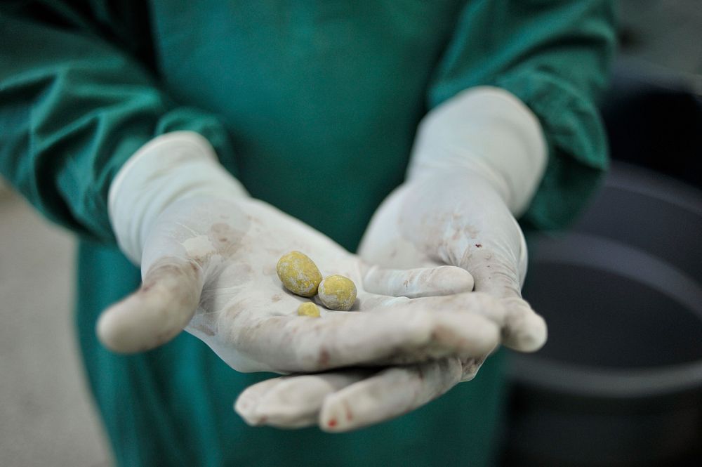 A surgeon at Banadir hospital in Mogadishu, Somalia, holds bladder stones recently removed from a patient on February 4. AU…