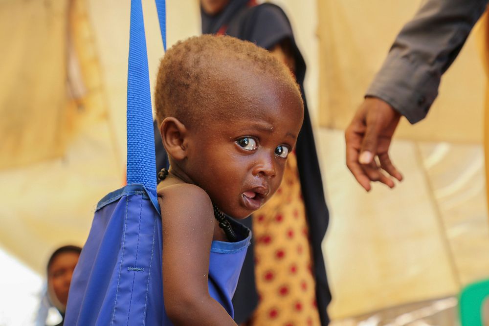A malnourished child on a weighing scale at one of the stabilization centers in Baidoa during a visit by Emergency…