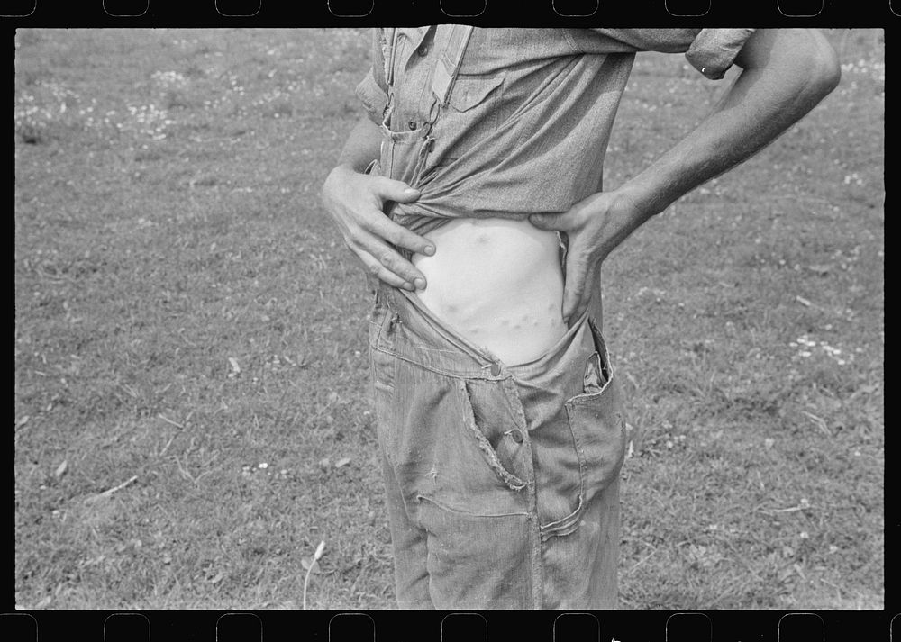 Member of threshing crew showing "chigger" bites, central Ohio. Sourced from the Library of Congress.