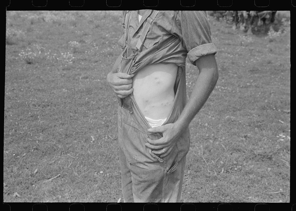 [Untitled photo, possibly related to: Member of threshing crew showing "chigger" bites, central Ohio]. Sourced from the…